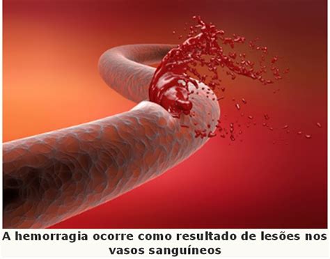 Tipos De Hemorragias Patologia Vs Diagnostico Images 88608 The Best