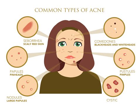 Acne What Causes Acne Problems