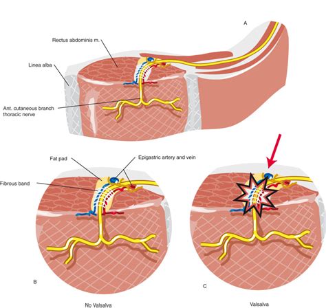 Anterior Cutaneous Nerve Entrapment Anesthesia Key