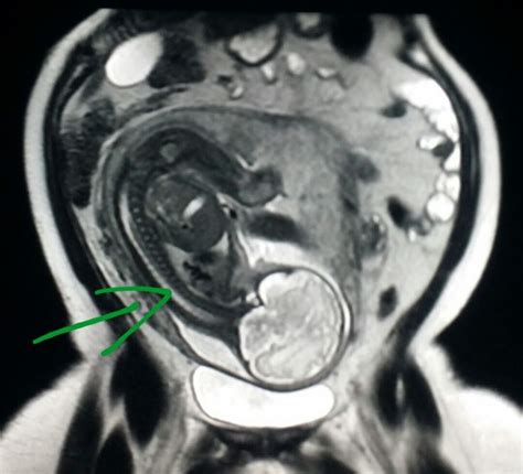 40 Best Mri Images On Pinterest Radiology Trauma And Brain