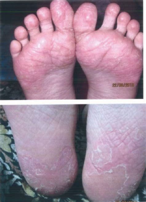 Plantar Psoriasis In Both Feet Area Before Treatment Dated August 22