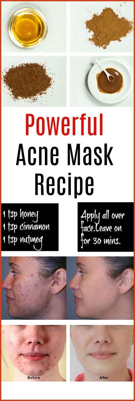Homemade Acne Treatment Homemade Acne Remedies Discover The Top 6
