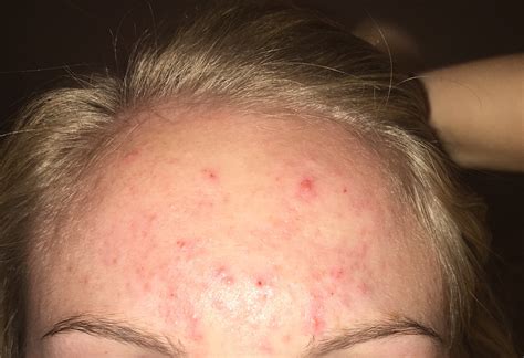 Forehead Acne Wont Heal General Acne Discussion Forum