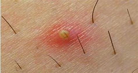 Ingrown armpit hairs are hairs that have curled around and grown back into your underarm skin instead of rising up from it. Everything About Ingrown Hairs and How to Remove Them ...