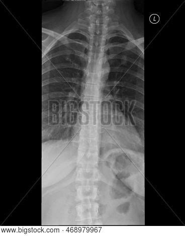 Thoracic Spine X Ray Image Photo Free Trial Bigstock