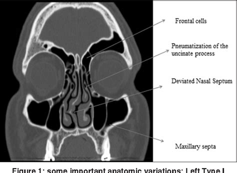 Computed Tomography Scan Correlation Between Anatomic Variations Of