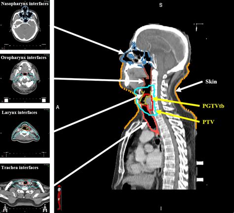 Frontiers Impact Of Magnetic Field On Dose Distribution In Mr Guided