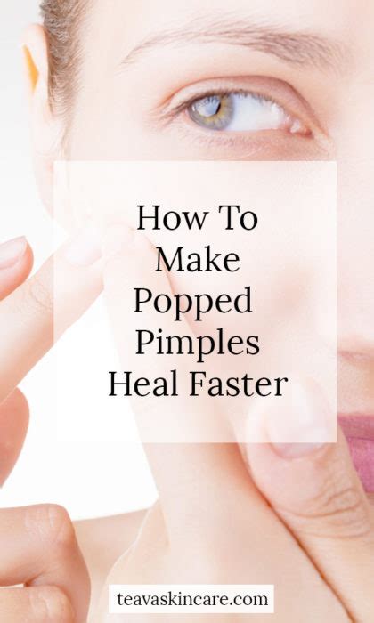 How To Make Popped Pimples Heal Faster Teava Skincare