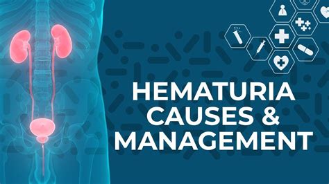 Despite most attention placed on two type systems (abo and rh), there are currently 35 systems recognized by the international society of blood transfusion. What are the Most Common Causes of Hematuria (Blood in ...