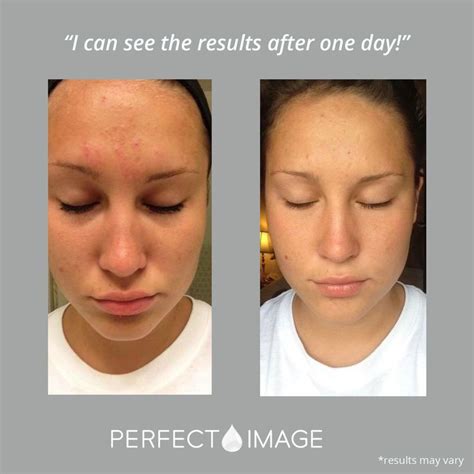 Glycolic 30 Gel Peel Chemical Peel Before And After Gel Chemical
