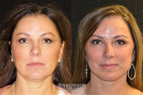 Facelift Neck Lift Before And After Pictures Case 29 Denver Co Ladner Facial Plastic Surgery