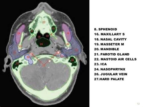 Ct Head Anatomy Labelled