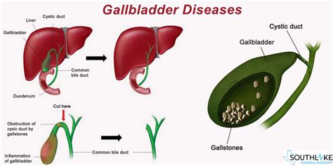 Gallbladder Diseases Overview Types And Diagnosis Southlake Texas