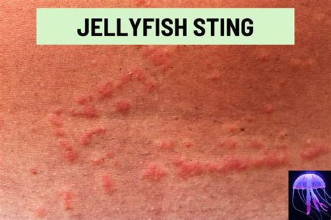 Red Lines On The Skin 9 Causes Pictures And Treatment