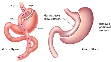15 Insanely Gastric Bypass Vs Sleeve Weight Loss Surgery Best Product Reviews