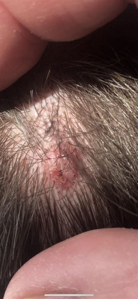 How To Know If You Have Skin Cancer On Scalp Is It Skin Cancer Cbs