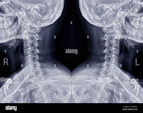 Lateral X Ray Cervical Spine Neck High Resolution Stock Photography And