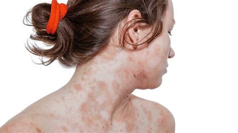 Dermatite At Pica Dermatologic Cl Nica De Dermatologia