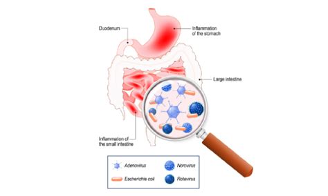 Bacteria, toxins, and parasites also can cause gastroenteritis. All About Gastroenteritis | Health Plus, Health News - AsiaOne