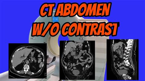 Ct Abdomen Without Contrast Youtube