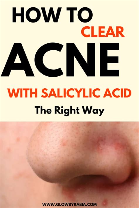 Everything You Need To Know About Salicylic Acid For Acne Artofit