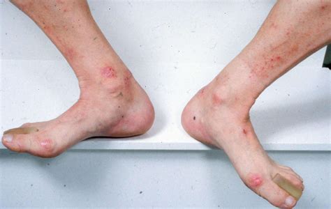 Skin Rash On Ankle