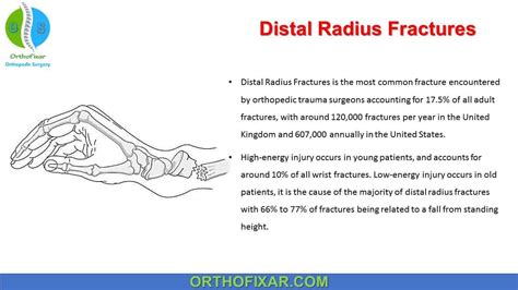 Distal Radius Fractures Orthofixar 2024