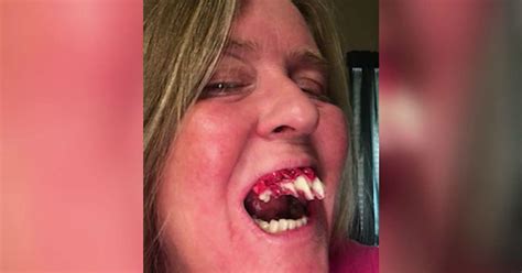Whether you buy your fangs or construct a diy set, you'll need some kind of fang glue to keep them in place. Woman needs medical help after zombie fangs stick to her ...