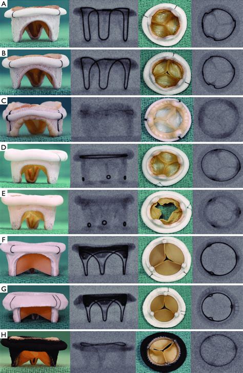 Surgical Bioprosthetic Mitral Valves And Their Fluoroscopic Appearance