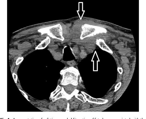 Figure From Serratia Marcescens Septic Sternoclavicular Joint Arthritis A Case Report