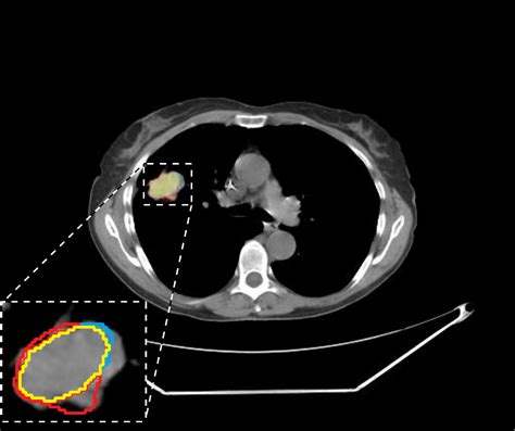 How Ai Can Detect Lung Cancer From Ct Scans Cadalyst