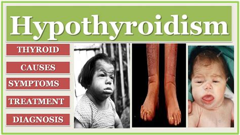 Thyroid Disease Hypothyroidism Cretinism Myxoedema Treatment