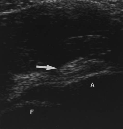 Extraarticular Snapping Hip Sonographic Findings Ajr