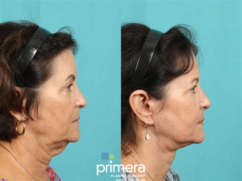 Neck Lift Before And After Pictures Case 774 Orlando Florida