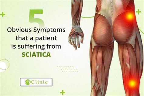 Obvious Symptoms That A Patient Is Suffering From Sciatica CT Clinic