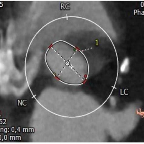 Ct Scan Measurements Of The Aortic Annulus Annulus Dimensions 1—min