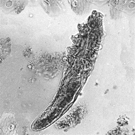 Whats The True Role Of Demodex Mites In The Development Of
