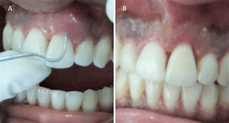 A Drainage Of Suppurative Periodontal Abscess Via Periodontal Pocket