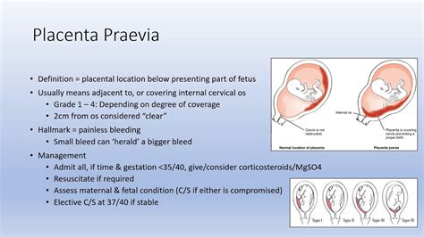 There are several types of placenta previa: Antepartum Haemorrhage APH - YouTube