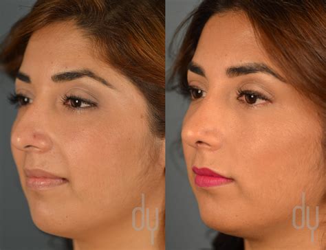 Nose Job Before And After Plastic Surgery Khaleej Mag