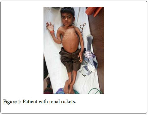 Pediatrics Therapeutics Patient Renal Rickets
