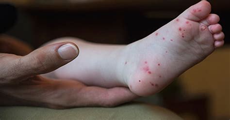Hand Foot And Mouth Disease On Tongue