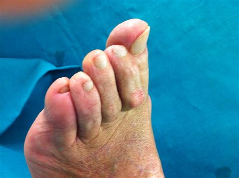 Dita a martello: patologia del piede