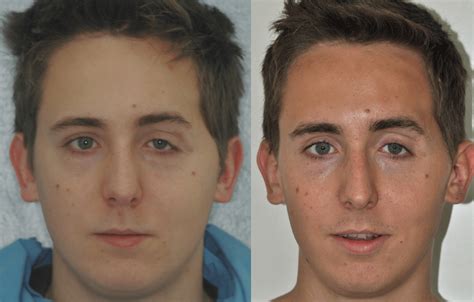 Remarkable Facial Reconstruction Surgery Medizzy Journal