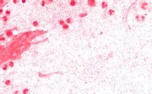 The bacteria can cause middle ear infections, sinusitis, and more serious infections, including meningitis. Haemophilus influenzae - Wikipedia