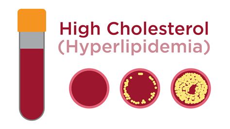 high cholesterol hyperlipidemia cardiogram