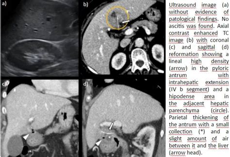 Gastrointestinal Perforation By A Fishbone A Radiological Diagnosis