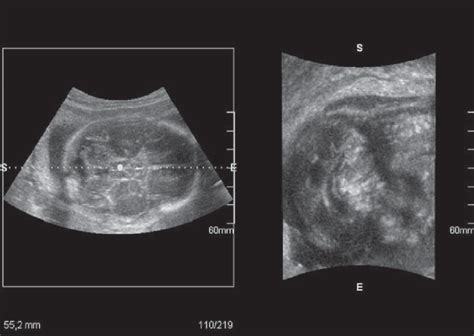 Ultrasound Of Fetal Skull In A Case Of Dandy Walker Syndrome Obv Mode