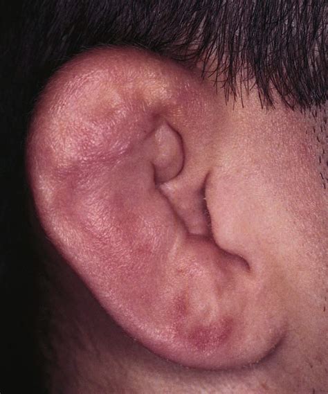 Study Medical Photos External Ear Injuries Brief Description With