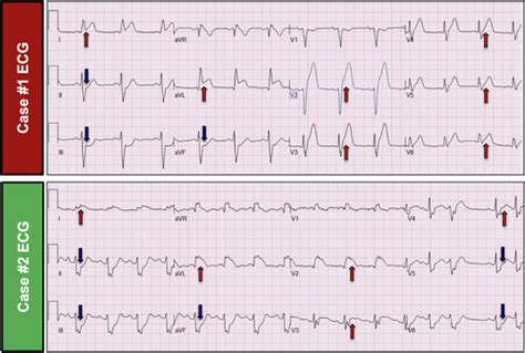 Electrocardiographic Recognition Of Unprotected Left Main St Segment